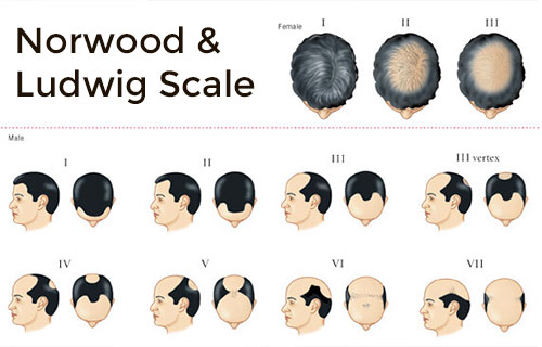 Non Surgical Hair Replacement in Hyderabad