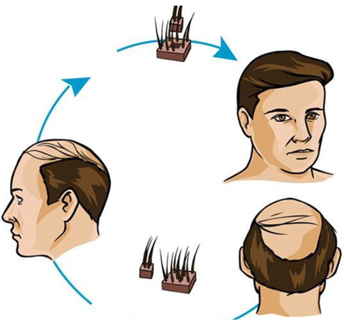 best non Surgical Hair Replacement in Hyderabad
